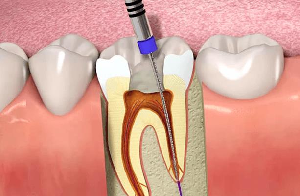 Lower The Risk - Root Canal Treatment