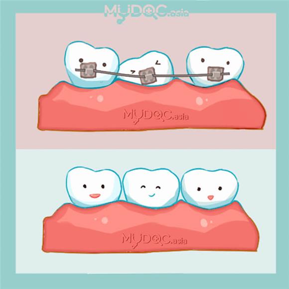 The Most Common Type - Position Teeth Improve Dental Health