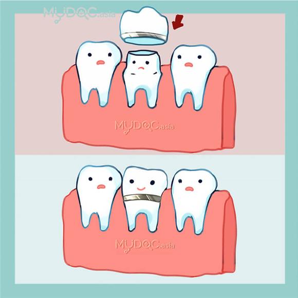 With Metal - Help Restore Teeth Covering Tooth